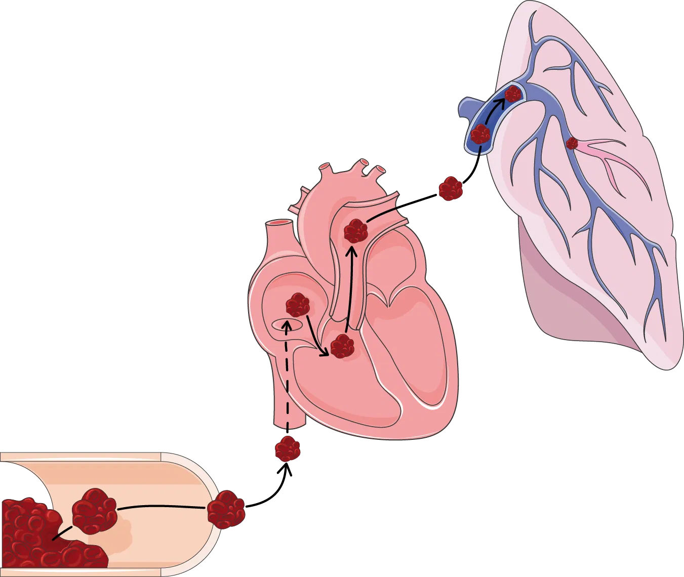 What Is Pulmonary Embolism? Understanding Causes, Symptoms, and Treatment