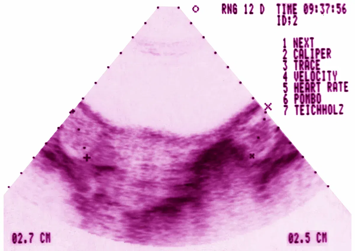 What Is PMOS? PCOS Renamed to Polyendocrine Metabolic Ovarian Syndrome