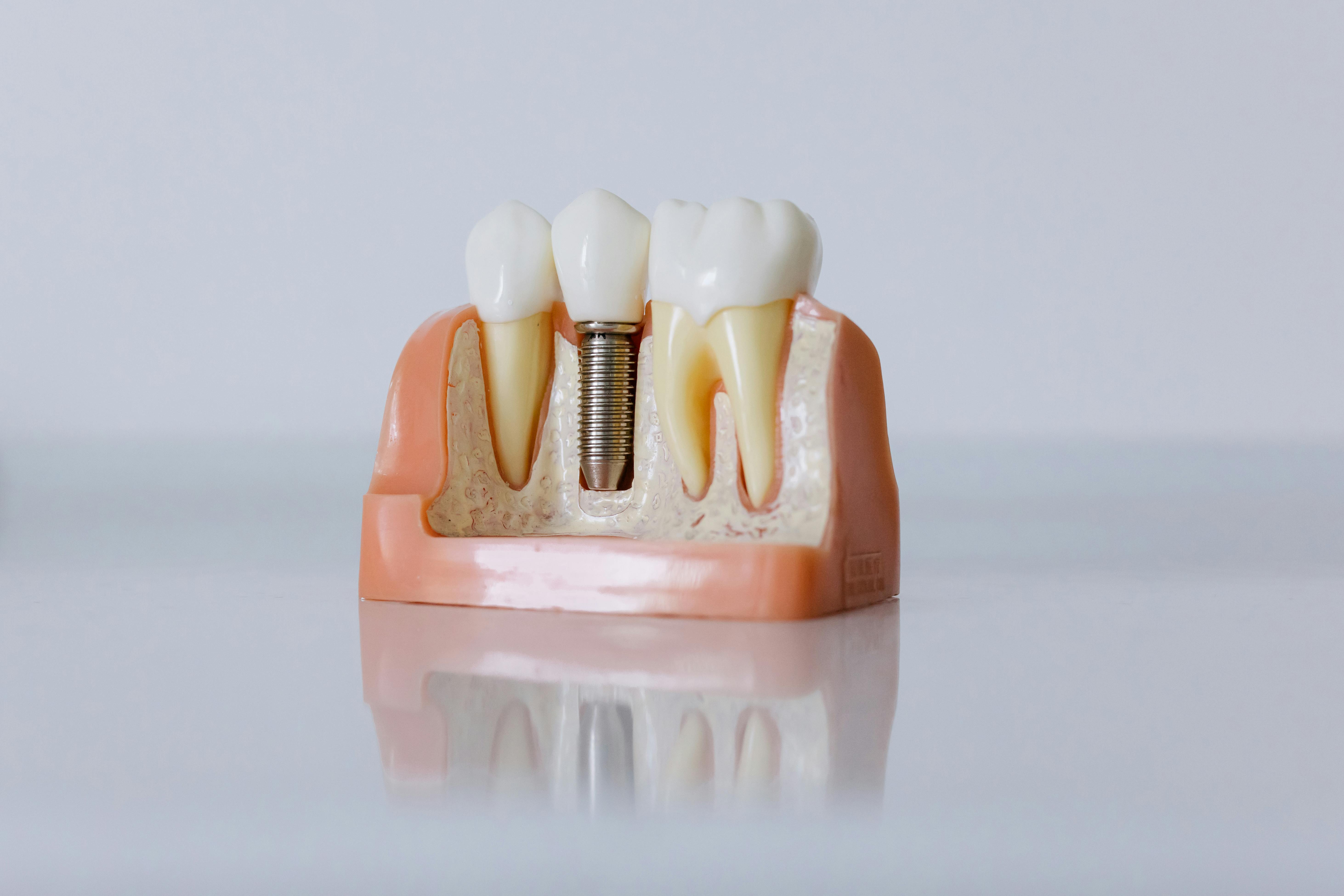 what are dental implants made of_7d153a19 145c 4365 a50e d974bb5917bf