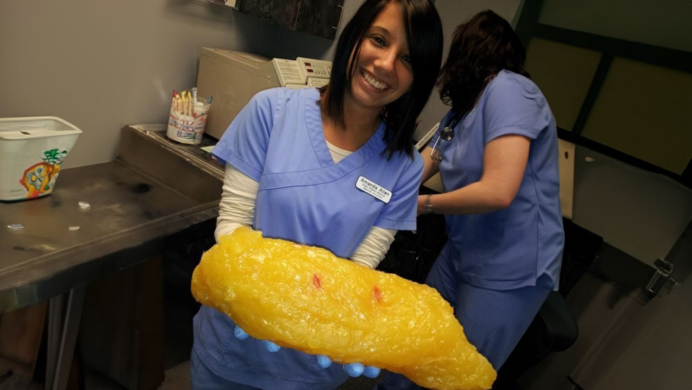 What Does 20lbs Of Fat Look Like