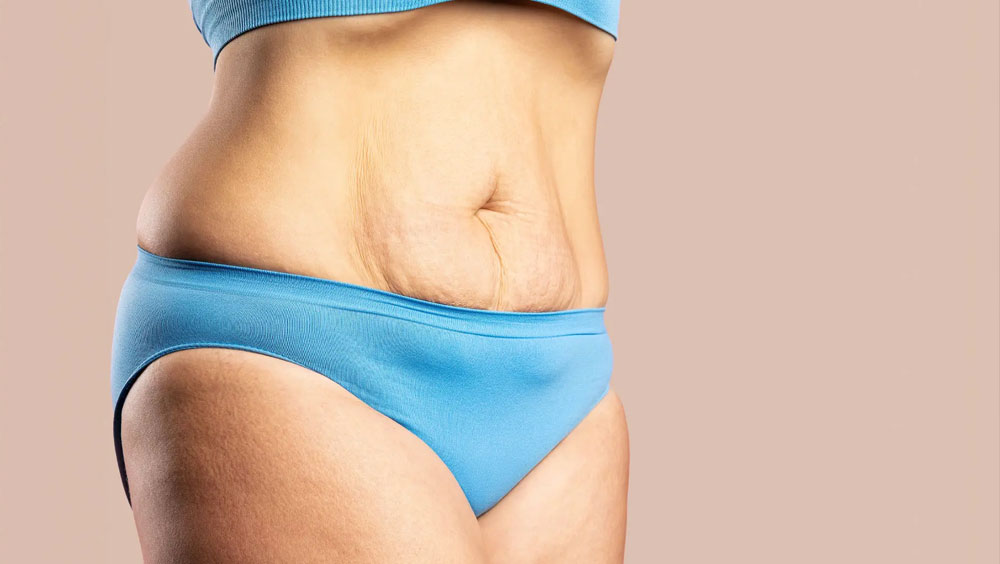 When Do Stretch Marks Go Away When You Lose Weight