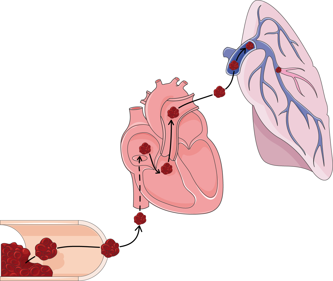 What Is Pulmonary Embolism? Understanding Causes, Symptoms, and Treatment