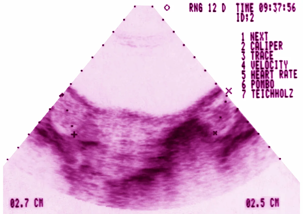 What Is PMOS? PCOS Renamed to Polyendocrine Metabolic Ovarian Syndrome